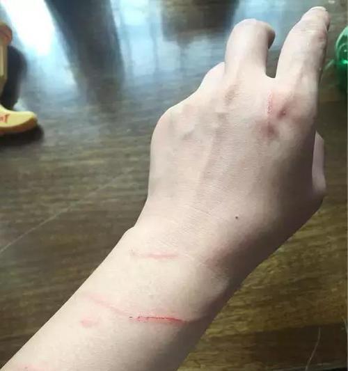 小狗舔伤口对人类健康的影响（如何正确处理被小狗舔的伤口）