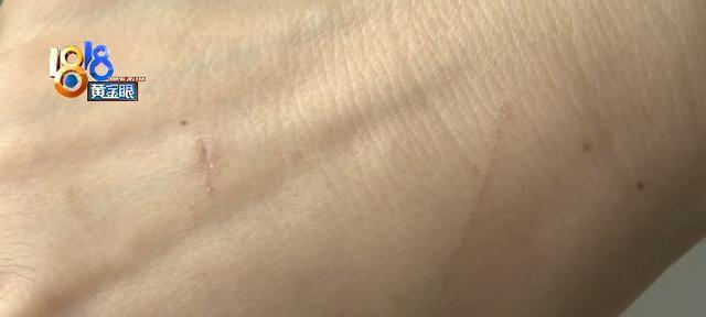 被猫抓伤应该怎么办（以宠物为主）
