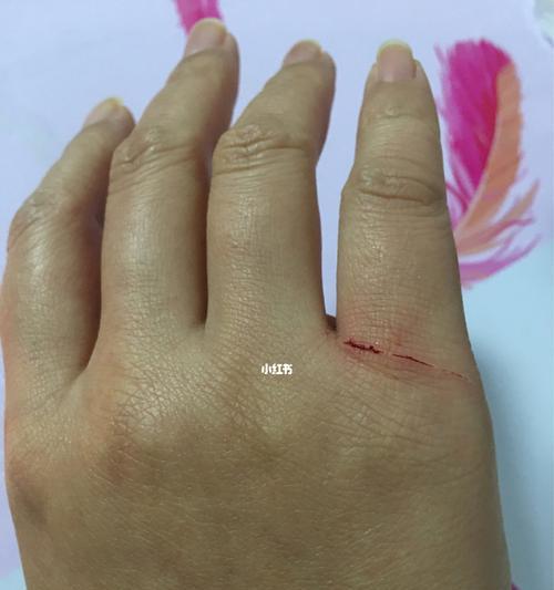 被猫抓伤后必须打针吗？预防狂犬病的必要性是什么？